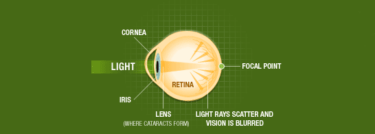Cataracts Chart